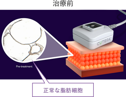 実際の脂肪細胞の変化の様子 治療前