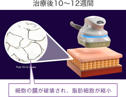 実際の脂肪細胞の変化の様子 治療後10〜12週間