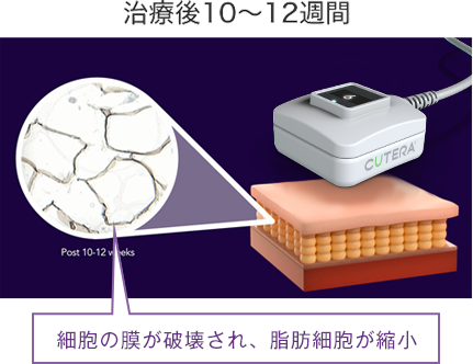 実際の脂肪細胞の変化の様子 治療後10〜12週間
