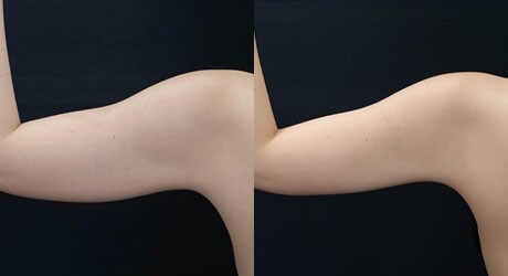 二の腕　メディカルサイズダウン　症例写真