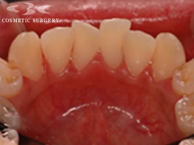 歯のクリーニング 歯の歯石や汚れの除去 美容歯科治療 湘南美容歯科