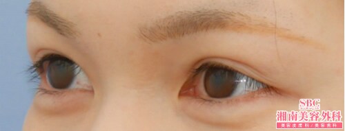 二重 二重整形の症例写真 則本翔 二重 二重整形 80ページ目 湘南美容クリニック 二重 二重整形の症例写真 則本翔 二重 二重整形 80ページ目 湘南美容クリニック