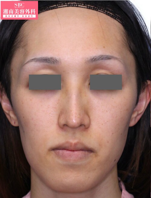 フェイスラインの症例写真（湘南美容クリニック、フェイスライン） 19 