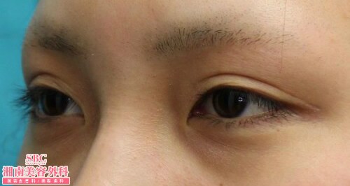 眼瞼下垂・下眼瞼下制法の施術 術前