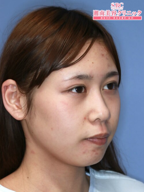 フェイスラインの症例写真（湘南美容クリニック、フェイスライン） 7 
