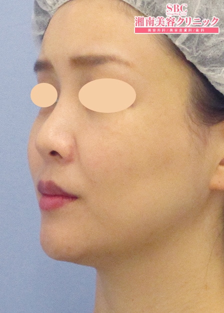 若返りの症例写真 若返り 617ページ目 湘南美容クリニック 若返りの症例写真 若返り 617ページ目 湘南美容クリニック