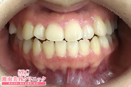 インビザライン Go 前歯のマウスピース矯正 矯正歯科 歯列矯正 湘南美容歯科