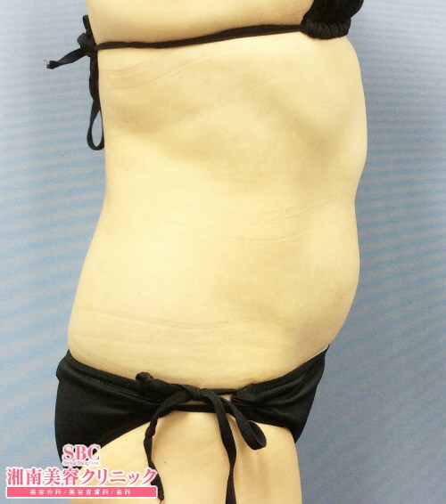 症例写真 医療ダイエット 湘南美容クリニック