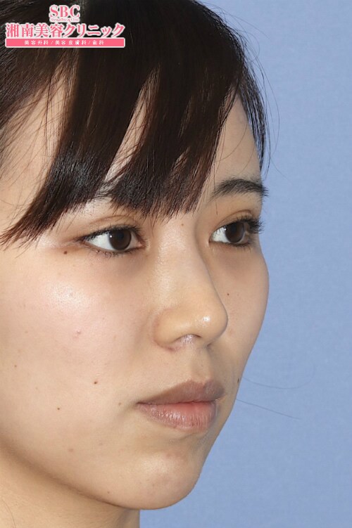 鼻形成 だんご鼻 わし鼻 豚鼻 の症例写真 No 鼻整形なら湘南美容クリニック