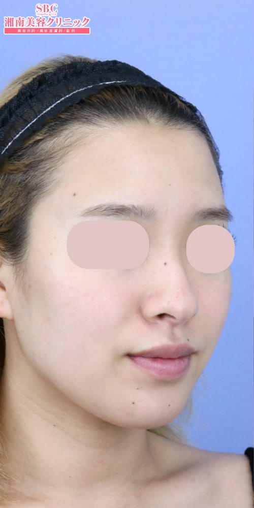 鼻形成 だんご鼻 わし鼻 豚鼻 の症例写真 No 2695 鼻整形なら湘南美容クリニック