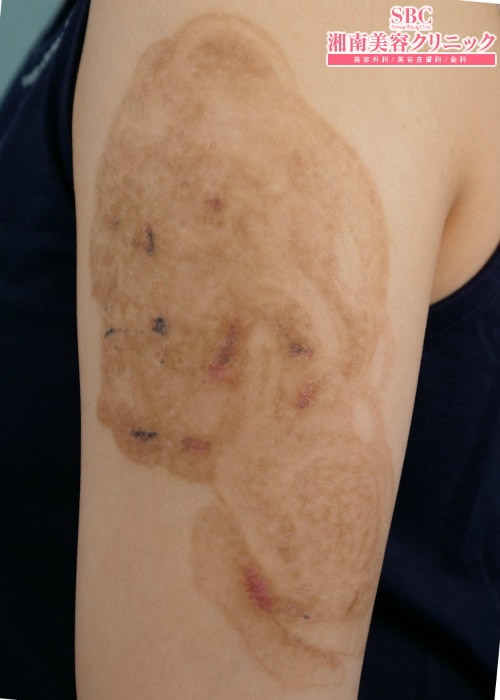 タトゥー除去の症例写真 タトゥー除去 2ページ目 湘南美容クリニック