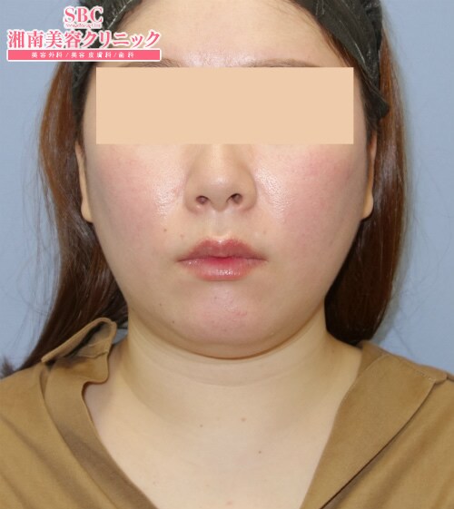 症例写真 医療ダイエット 湘南美容クリニック