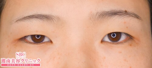 症例 目 整形