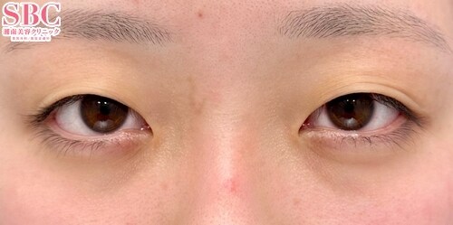 術前