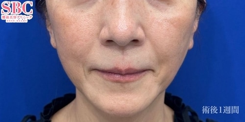 糸リフト・ヒアルロン酸注入(50代/女性) の術後の症例写真
