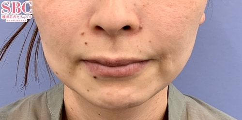糸リフト・ヒアルロン酸注入・ボトックス(30代/女性) の術前の症例写真