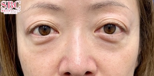 目の下の切らないクマ・たるみ(ふくらみ)取り、コンデンスリッチフェイス法(40代前半/女性)の術前の症例写真