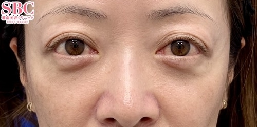 目の下の切らないクマ・たるみ(ふくらみ)取り、コンデンスリッチフェイス法(40代前半/女性)の術後の症例写真