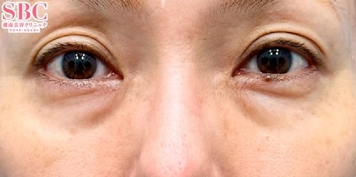 目の下の切らないクマ・たるみ(ふくらみ)取り、コンデンスリッチフェイス法(50代前半/女性)の術前の症例写真