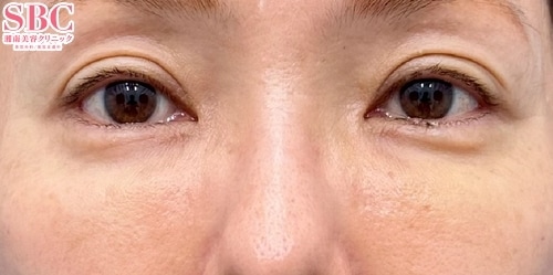 目の下の切らないクマ・たるみ(ふくらみ)取り、コンデンスリッチフェイス法(50代前半/女性)の術後の症例写真