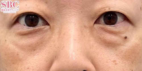 目の下の切らないクマ・たるみ(ふくらみ)取り、コンデンスリッチフェイス法(40代前半/女性)の術前の症例写真