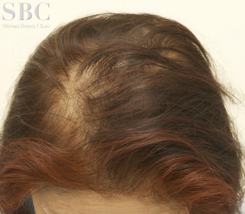 症例写真】７３歳の女性でも 髪の毛が増える 薬だけで 育毛｜湘南AGA