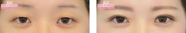 井上礎馬医師｜クイックコスメティークNeo｜施術前後の症例写真