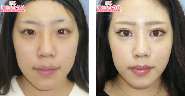 春山いずみ医師|全切開法二重術|施術前後の症例写真