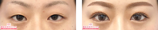 西村枝里子医師｜フォーエバー二重術｜施術前後の症例写真