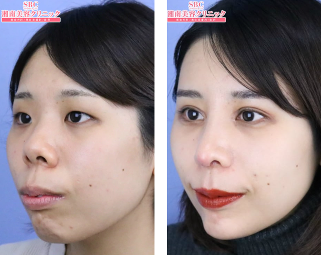 居川和広医師｜鼻中隔延長術（肋軟骨）、小鼻縮小（フラップ）、鼻尖形成術3D法｜施術前後の症例写真