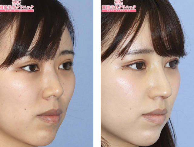 鼻を高く ヒアルロン酸 プロテーゼ の鼻整形の症例写真一覧 鼻整形なら湘南美容クリニック
