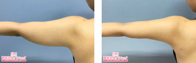 西村枝里子 医師｜Aquicell（アキーセル）脂肪吸引｜施術前後の症例写真