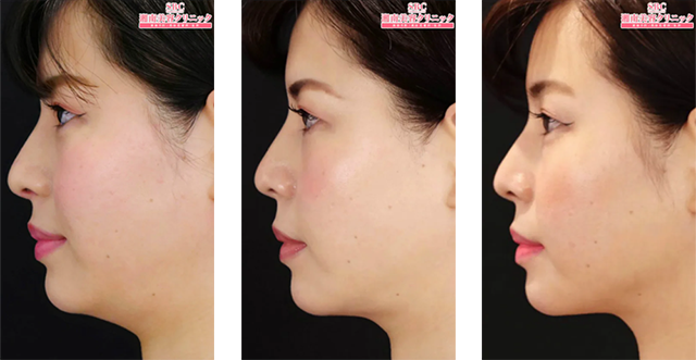 クールスカルプティングとは何ですか?