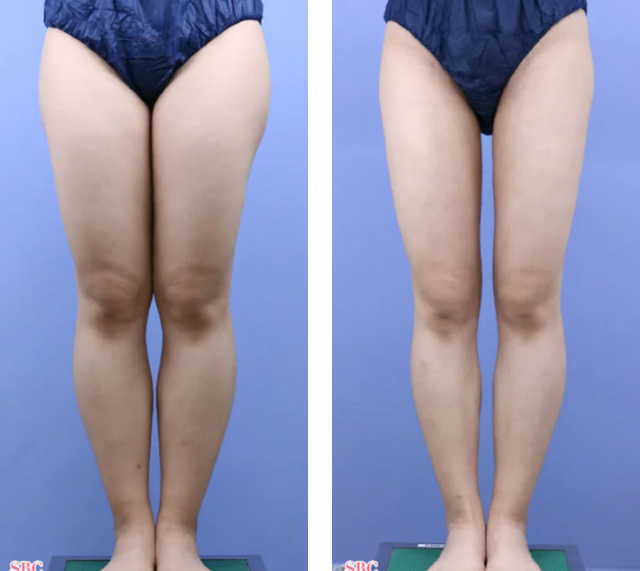 須田陽一 医師｜ライポマティック脂肪吸引｜施術前後の症例写真