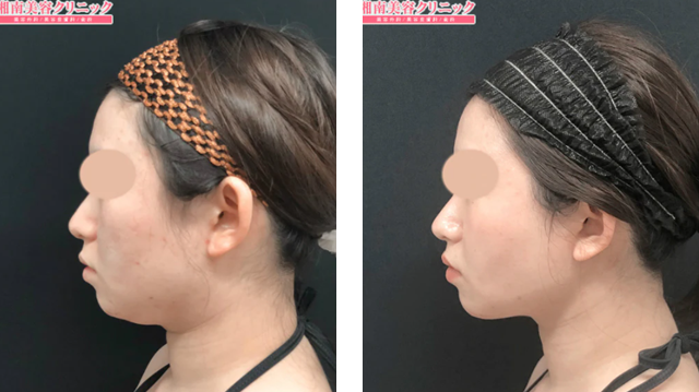 西村枝里子  医師｜根こそぎVASER脂肪吸引｜施術前後の症例写真