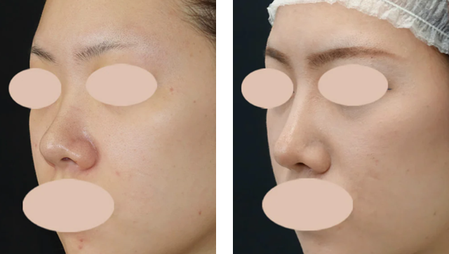 中野達生医師｜SBCプレミアムソフトプロテーゼ、鼻尖形成術3D法、鼻尖部軟骨移植｜施術前後の症例写真