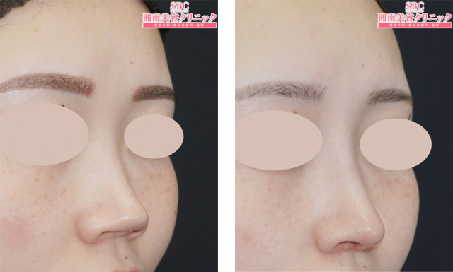 本間重行医師｜SBCプレミアムソフトプロテーゼ、鼻中隔延長術（鼻中隔軟骨）、鼻尖形成術3D法｜施術前後の症例写真