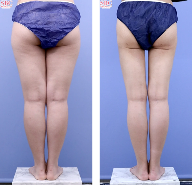 須田陽一医師｜Aquicell（アキーセル）脂肪吸引、根こそぎVASER脂肪吸引｜施術前後の症例写真