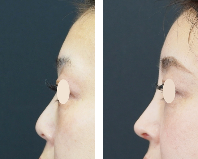 本間重行医師｜鼻尖形成術3D法、鼻中隔延長術（鼻中隔軟骨）、鼻柱下降術｜施術前後の症例写真