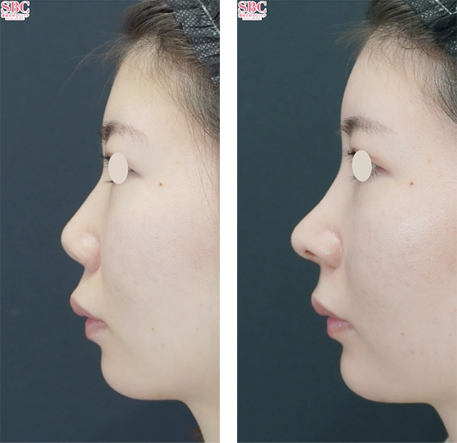 本間重行医師｜SBCナチュラルフィットプロテーゼ、鼻尖形成術3D法、鼻尖部軟骨移植｜施術前後の症例写真