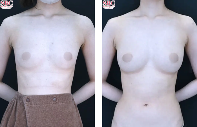 田中龍二医師｜セルーション(脂肪注入豊胸)｜施術前後の症例写真