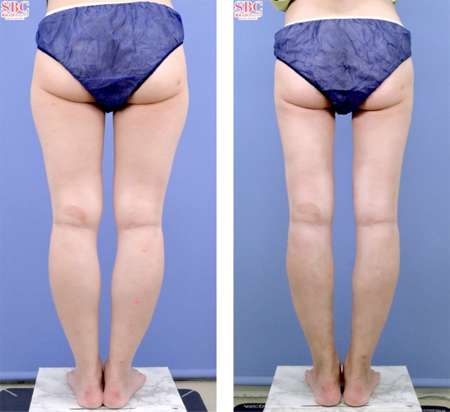 須田陽一医師｜Aquicell（アキーセル）脂肪吸引、ライポマティック脂肪吸引、根こそぎVASER脂肪吸引｜施術前後の症例写真