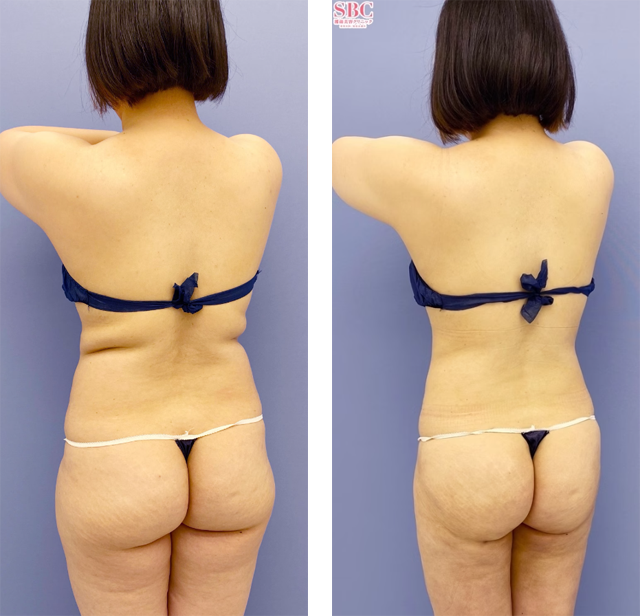 葛島魁人医師｜Aquicell（アキーセル）脂肪吸引、根こそぎVASER脂肪吸引｜施術前後の症例写真