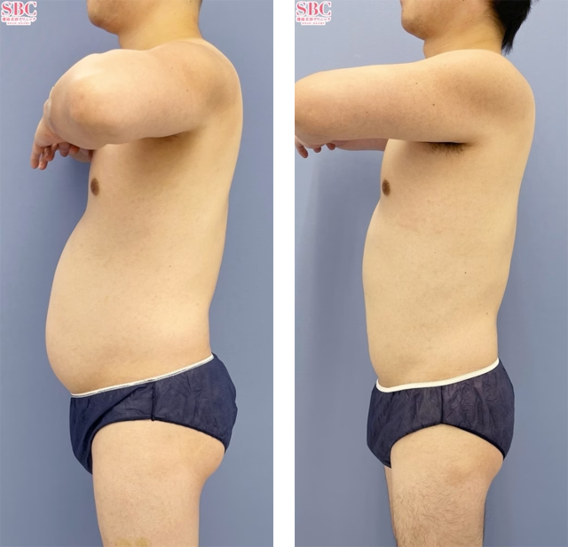 葛島魁人医師｜Aquicell（アキーセル）脂肪吸引、根こそぎVASER脂肪吸引｜施術前後の症例写真