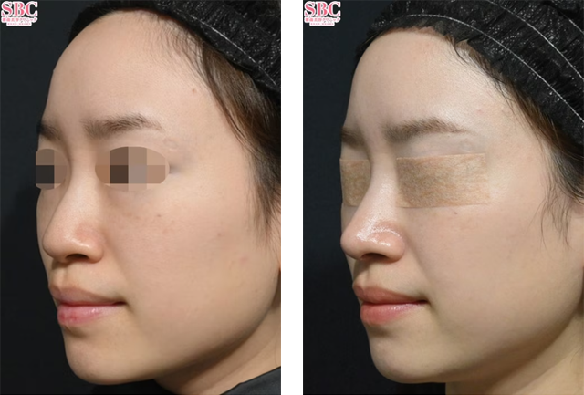 居川和広医師｜鼻尖形成術3D法、鼻中隔延長術（鼻中隔軟骨）、鼻尖部軟骨移植｜施術前後の症例写真