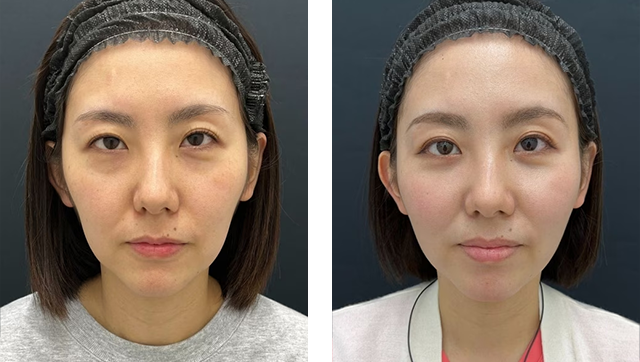 檜山和弘医師｜裏ハムラ法、テスリフト、VOV（ボブ）リフト｜施術前後の症例写真