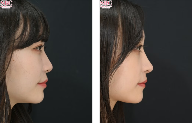 居川和広医師｜他院修正｜施術前後の症例写真