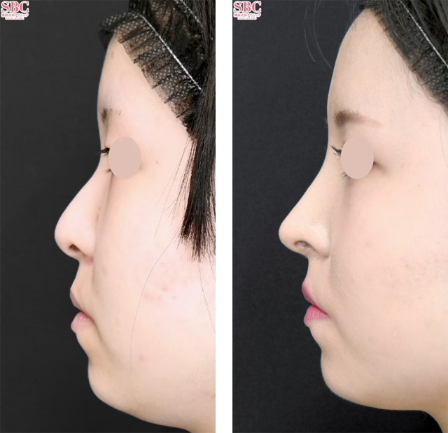 本間重行医師｜SBCプレミアムソフトプロテーゼ、鼻尖形成術3D法、鼻尖部軟骨移植｜施術前後の症例写真