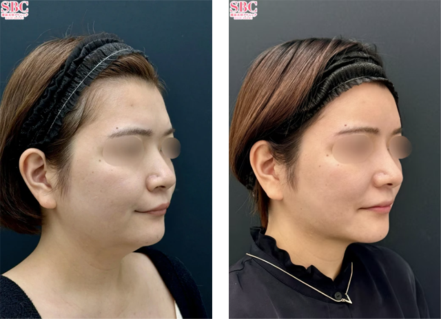 藤巻直人医師｜小顔用脂肪吸引注射｜施術前後の症例写真