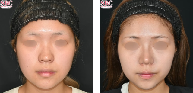 中野達生医師｜SBCプレミアムソフトプロテーゼ、鼻尖形成術3D法、鼻柱下降術｜施術前後の症例写真